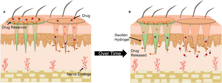 Diagram of drug release using microneedle technology